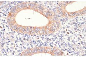 Immunohistochemistry of paraffin-embedded Human uterine cancer using HMGCR Polyclonal Antibody at dilution of 1:200 (40x lens). (HMGCR anticorps)