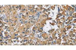 Immunohistochemistry of paraffin-embedded Human thyroid cancer tissue using ZMYND11 Polyclonal Antibody at dilution 1:70