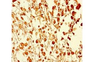 Immunohistochemistry of paraffin-embedded human melanoma using ABIN7174595 at dilution of 1:100 (UBXN2B anticorps  (AA 2-250))