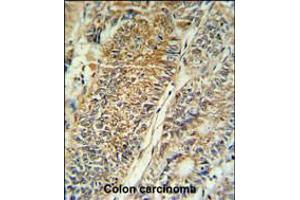 PYCR1 Antibody IHC analysis in formalin fixed and paraffin embedded colon carcinoma followed by peroxidase conjugation of the secondary antibody and DAB staining.