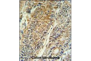 PYCR1 Antibody IHC analysis in formalin fixed and paraffin embedded colon carcinoma followed by peroxidase conjugation of the secondary antibody and DAB staining. (PYCR1 anticorps  (C-Term))