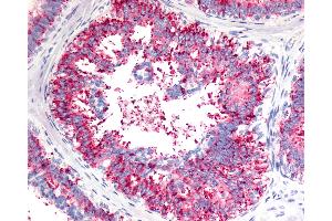 Anti-V1RL1 / VN1R1 antibody IHC of human Breast, Carcinoma. (VN1R1 anticorps  (C-Term))