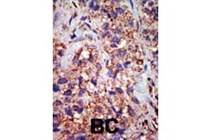 Formalin-fixed and paraffin-embedded human cancer tissue reacted with the primary antibody, which was peroxidase-conjugated to the secondary antibody, followed by DAB staining. (USP8 anticorps  (C-Term))