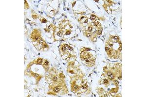 Immunohistochemistry of paraffin-embedded human liver cancer using RRAGD antibody (ABIN6132084, ABIN6147254, ABIN6147255 and ABIN6225325) at dilution of 1:100 (40x lens). (RRAGD anticorps  (AA 181-400))