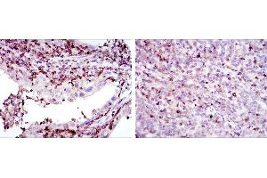 Immunohistochemical analysis of paraffin-embedded endometrial cancer tissues (left) and cervical cancer tissues (right) using GRK2 mouse mAb with DAB staining.