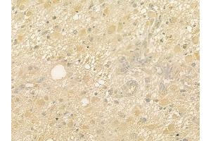 ABIN6264322 and ABIN6277635 at 1/100 staining human astrocytoma by IHC-P. (PNMT anticorps  (N-Term))
