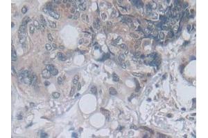 Detection of MTHFR in Human Colorectal cancer Tissue using Polyclonal Antibody to Methylenetetrahydrofolate Reductase (MTHFR)