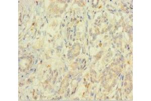 Immunohistochemistry of paraffin-embedded human pancreatic cancer using ABIN7152209 at dilution of 1:100 (EIF5 anticorps  (AA 1-431))