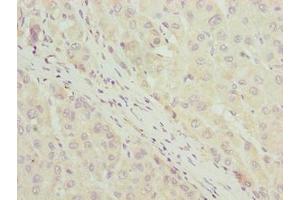 Immunohistochemistry of paraffin-embedded human liver cancer using ABIN7158480 at dilution of 1:100 (Uncharacterized Protein C7orf34 (LLCFC1) (AA 29-122) anticorps)