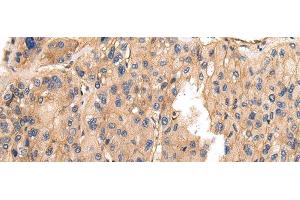 Immunohistochemistry of paraffin-embedded Human liver cancer using VAMP5 Polyclonal Antibody at dilution of 1/25 (VAMP5 anticorps)