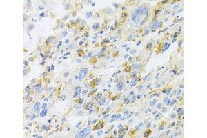 Immunohistochemistry of paraffin-embedded Human liver cancer using CXCR3 Polyclonal Antibody at dilution of 1:100 (40x lens). (CXCR3 anticorps)