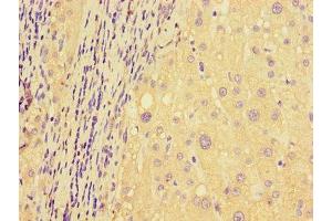 Immunohistochemistry of paraffin-embedded human liver cancer using ABIN7150136 at dilution of 1:100 (DDIT4L anticorps  (AA 1-163))