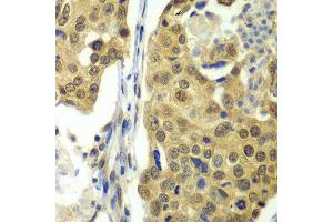 Immunohistochemistry of paraffin-embedded human lung cancer using DDX1 antibody at dilution of 1:100 (x40 lens).