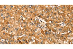 Immunohistochemistry of paraffin-embedded Human liver cancer using TRIM62 Polyclonal Antibody at dilution of 1:30 (TRIM62 anticorps)