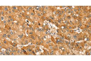 Immunohistochemistry of paraffin-embedded Human liver cancer using TRIM62 Polyclonal Antibody at dilution of 1:30