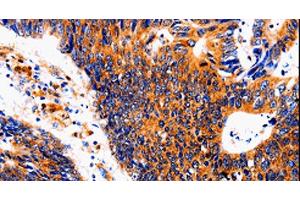Immunohistochemistry of paraffin-embedded Human colon cancer tissue using IL18BP Polyclonal Antibody at dilution 1:50 (IL18BP anticorps)