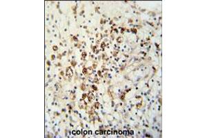 HAUS5 Antibody immunohistochemistry analysis in formalin fixed and paraffin embedded human colon carcinoma followed by peroxidase conjugation of the secondary antibody and DAB staining. (HAUS5 anticorps  (N-Term))