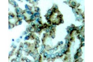 Immunohistochemistry of paraffin-embedded Human lung carcinoma tissue, using Phospho-PKCalpha/beta II(T638/641) Polyclonal Antibody (PRKCA beta 2 anticorps  (pThr638, pThr641))