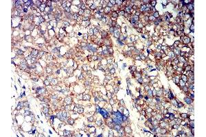 Immunohistochemical analysis of paraffin-embedded breast cancer tissues using ATG3 mouse mAb with DAB staining. (ATG3 anticorps  (AA 1-100))