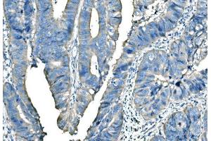 IHC analysis of B Raf/BRAF using anti-B Raf/BRAF antibody (ABIN3043761). (BRAF anticorps  (AA 38-230))