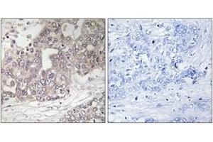 Immunohistochemistry analysis of paraffin-embedded human liver carcinoma tissue, using ATG4C Antibody. (ATG4C anticorps  (AA 21-70))