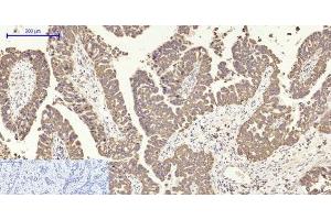 Immunohistochemistry of paraffin-embedded Human liver cancer tissue using COX2 Polyclonal Antibody at dilution of 1:200.