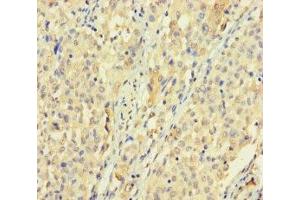 Immunohistochemistry of paraffin-embedded human lung cancer using ABIN7170528 at dilution of 1:100 (SPATS1 anticorps  (AA 1-300))