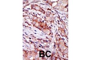 Formalin-fixed and paraffin-embedded human cancer tissue reacted with the primary antibody, which was peroxidase-conjugated to the secondary antibody, followed by AEC staining. (KIP2 (AA 8-37), (N-Term) anticorps)