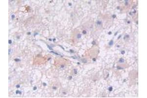 IHC-P analysis of Human Glioma Tissue, with DAB staining. (EGFR anticorps  (AA 713-984))