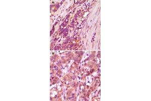 Immunohistochemical analysis of paraffin-embedded human stomach carcinoma(A) and breast carcinoma (B) tissue, showing cytoplasmical localization, using FBLN5 monoclonal antibody, clone 3F10A5, 3F8A12  with DAB staining.