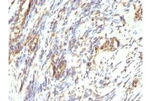 Formalin-fixed, paraffin-embedded human Leiomyosarcoma stained with anti-Vimentin antibody. (Vimentin anticorps)