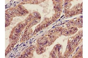 Immunohistochemistry of paraffin-embedded human endometrial cancer using ABIN7142023 at dilution of 1:100
