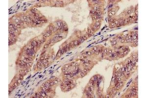 Immunohistochemistry of paraffin-embedded human endometrial cancer using ABIN7142023 at dilution of 1:100 (AGPAT5 anticorps  (AA 174-313))