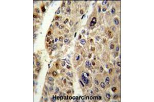 Formalin-fixed and paraffin-embedded human hepatocarcinoma reacted with SERPINC1 Antibody , which was peroxidase-conjugated to the secondary antibody, followed by DAB staining. (SERPINC1 anticorps  (C-Term))