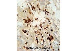 WDR21C antibody (N-term) immunohistochemistry analysis in formalin fixed and paraffin embedded human colon carcinoma followed by peroxidase conjugation of the secondary antibody and DAB staining.