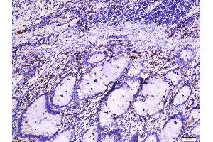 Formalin-fixed and paraffin embedded human colon cancer tissue labeled with Anti-Beta-Catenin (Ser33 + 37) Polyclonal Antibody, Unconjugated  at 1:200 followed by conjugation to the secondary antibody and DAB staining.