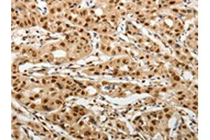The image on the left is immunohistochemistry of paraffin-embedded Human lung cancer tissue using ABIN7192598(SOCS7 Antibody) at dilution 1/30, on the right is treated with synthetic peptide. (SOCS7 anticorps)