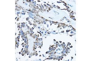 Immunohistochemistry of paraffin-embedded human thyroid cancer using O Rabbit pAb (ABIN6133230, ABIN6137338, ABIN6137339 and ABIN6224128) at dilution of 1:100 (40x lens). (ATP5O anticorps  (AA 24-213))