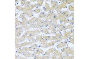 Immunohistochemistry of paraffin-embedded human liver injury using BCKDK antibody (ABIN5974802) at dilution of 1/100 (40x lens). (BCKDK anticorps)