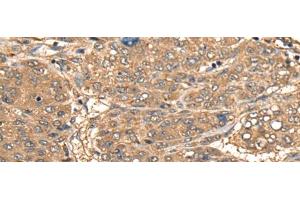 Immunohistochemistry of paraffin-embedded Human liver cancer tissue using CCL27 Polyclonal Antibody at dilution of 1:55(x200) (CCL27 anticorps)