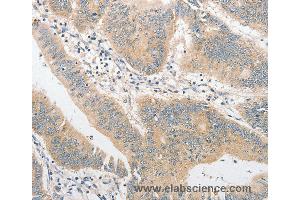 Immunohistochemistry of Human colon cancer using TLR4 Polyclonal Antibody at dilution of 1:40 (TLR4 anticorps)