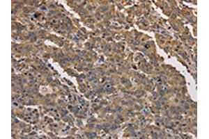 The image on the left is immunohistochemistry of paraffin-embedded Human liver cancer tissue using ABIN7191171(KCNG1 Antibody) at dilution 1/40, on the right is treated with synthetic peptide. (KCNG1 anticorps)