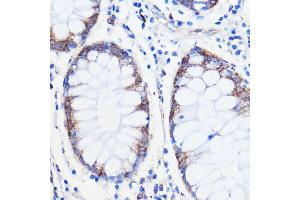 Immunohistochemistry of paraffin-embedded human colon carcinoma using TMED3 antibody (ABIN7270944) at dilution of 1:100 (40x lens).