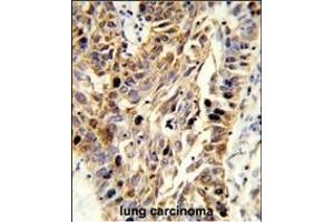 Formalin-fixed and paraffin-embedded human lung carcinoma reacted with EFE Antibody (N-term), which was peroxidase-conjugated to the secondary antibody, followed by DAB staining.