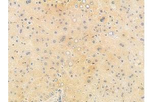 ABIN6265357 and ABIN6278222 at 1/100 staining human hepatocellular carcinoma by IHC-P.