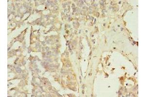 Immunohistochemistry of paraffin-embedded human endometrial cancer using ABIN7176501 at dilution of 1:100 (ZNF699 anticorps  (AA 19-195))