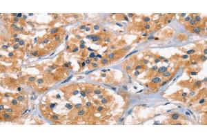Immunohistochemistry of paraffin-embedded Human thyroid cancer tissue using AHR Polyclonal Antibody at dilution 1:50 (Aryl Hydrocarbon Receptor anticorps)