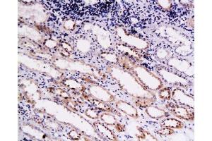 Formalin-fixed and paraffin embedded human kidney carcinoma labeled with Anti-Endostatin Polyclonal Antibody , Unconjugated at 1:200, followed by conjugation to the secondary antibody and DAB staining