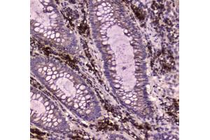 IHC testing of FFPE human intestinal cancer tissue with M6PR antibody at 1ug/ml. (IGF2R anticorps)