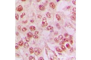 Immunohistochemical analysis of Galectin 3 staining in human lung cancer formalin fixed paraffin embedded tissue section.